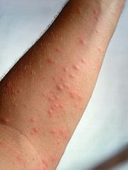 insect bites
